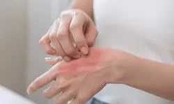 Kaşıntı yalnızca bir cilt sorunu olarak ele alınmamalı!